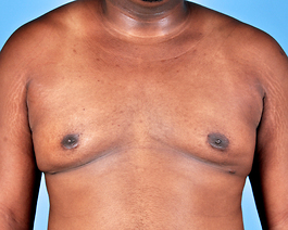 Gynecomastia Before and After | Dr. Thomas Hubbard