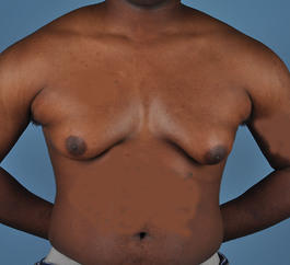 Gynecomastia Before and After | Dr. Thomas Hubbard