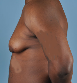 Gynecomastia Before and After | Dr. Thomas Hubbard