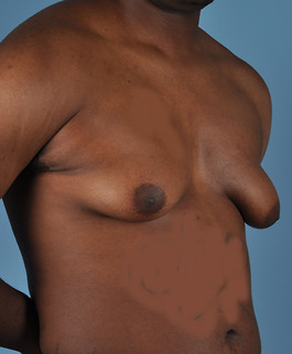 Gynecomastia Before and After | Dr. Thomas Hubbard