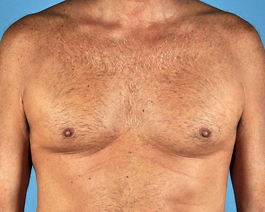 Gynecomastia Before and After | Dr. Thomas Hubbard