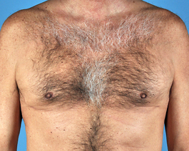 Gynecomastia Before and After | Dr. Thomas Hubbard