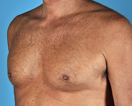 Gynecomastia Before and After | Dr. Thomas Hubbard