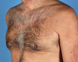 Gynecomastia Before and After | Dr. Thomas Hubbard