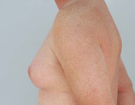 Gynecomastia Before and After | Dr. Thomas Hubbard