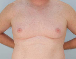 Gynecomastia Before and After | Dr. Thomas Hubbard