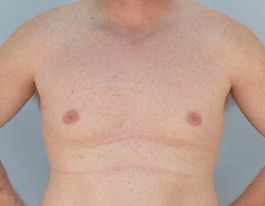 Gynecomastia Before and After | Dr. Thomas Hubbard