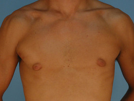 Gynecomastia Before and After | Dr. Thomas Hubbard