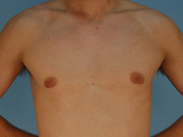 Gynecomastia Before and After | Dr. Thomas Hubbard