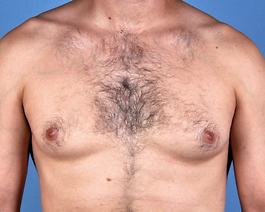 Gynecomastia Before and After | Dr. Thomas Hubbard