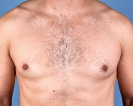 Gynecomastia Before and After | Dr. Thomas Hubbard