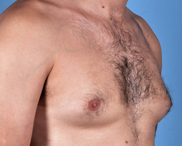 Gynecomastia Before and After | Dr. Thomas Hubbard