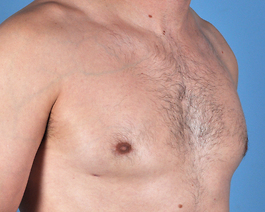 Gynecomastia Before and After | Dr. Thomas Hubbard