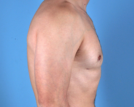 Gynecomastia Before and After | Dr. Thomas Hubbard