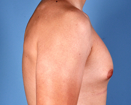 Gynecomastia Before and After | Dr. Thomas Hubbard