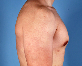 Gynecomastia Before and After | Dr. Thomas Hubbard