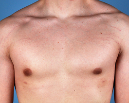 Gynecomastia Before and After | Dr. Thomas Hubbard