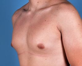 Gynecomastia Before and After | Dr. Thomas Hubbard