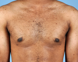 Gynecomastia Before and After | Dr. Thomas Hubbard