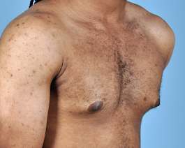 Gynecomastia Before and After | Dr. Thomas Hubbard