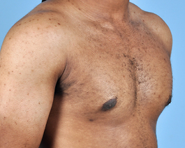 Gynecomastia Before and After | Dr. Thomas Hubbard