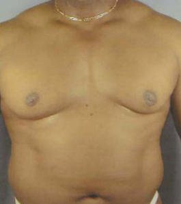 Gynecomastia Before and After | Dr. Thomas Hubbard