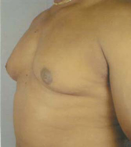 Gynecomastia Before and After | Dr. Thomas Hubbard