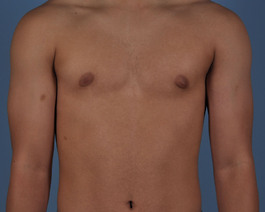 Gynecomastia Before and After | Dr. Thomas Hubbard