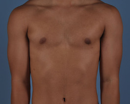 Gynecomastia Before and After | Dr. Thomas Hubbard