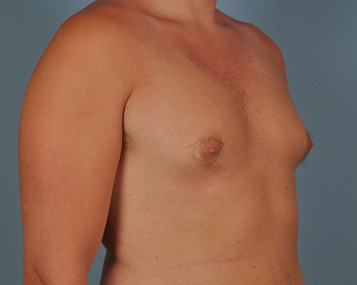 Gynecomastia Before and After | Dr. Thomas Hubbard