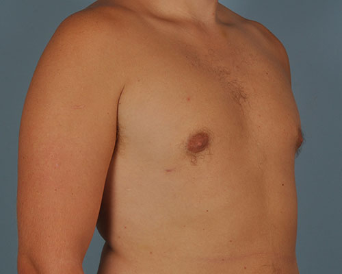 Gynecomastia Before and After | Dr. Thomas Hubbard