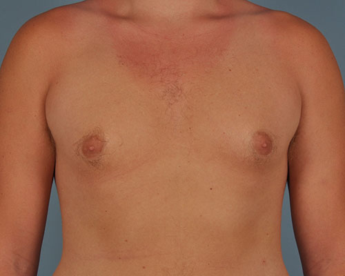 Gynecomastia Before and After | Dr. Thomas Hubbard