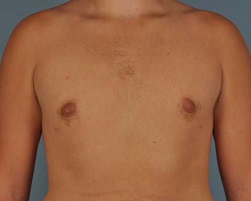 Gynecomastia Before and After | Dr. Thomas Hubbard