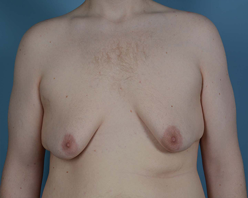 Gynecomastia Before and After | Dr. Thomas Hubbard