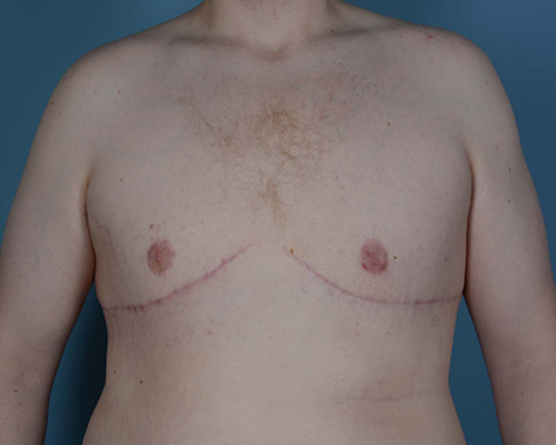 Gynecomastia Before and After | Dr. Thomas Hubbard