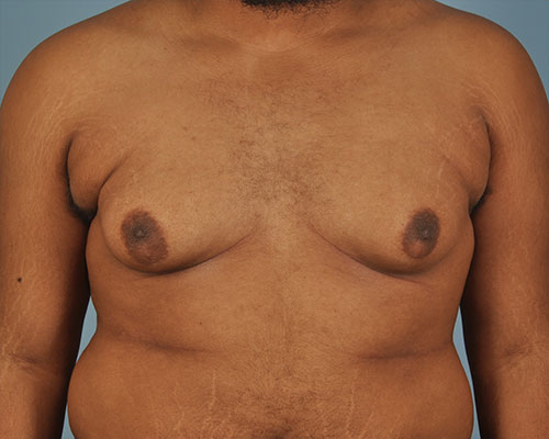 Gynecomastia Before and After | Dr. Thomas Hubbard