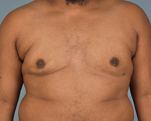 Gynecomastia Before and After | Dr. Thomas Hubbard