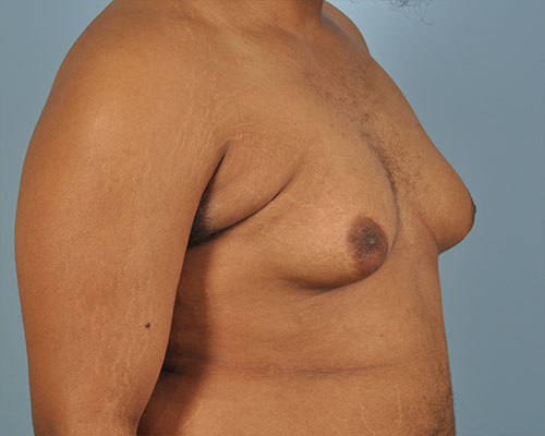 Gynecomastia Before and After | Dr. Thomas Hubbard