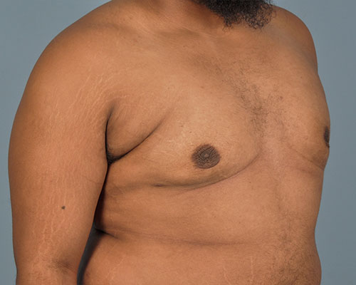 Gynecomastia Before and After | Dr. Thomas Hubbard