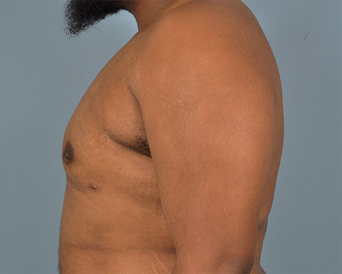 Gynecomastia Before and After | Dr. Thomas Hubbard