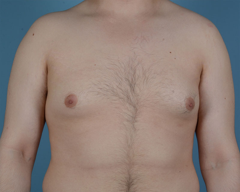 Gynecomastia Before and After | Dr. Thomas Hubbard