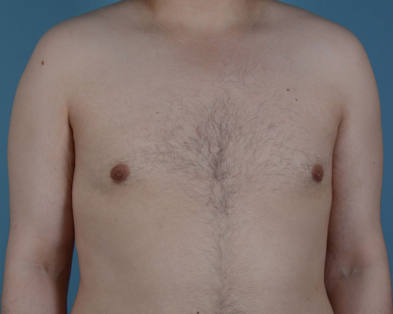 Gynecomastia Before and After | Dr. Thomas Hubbard