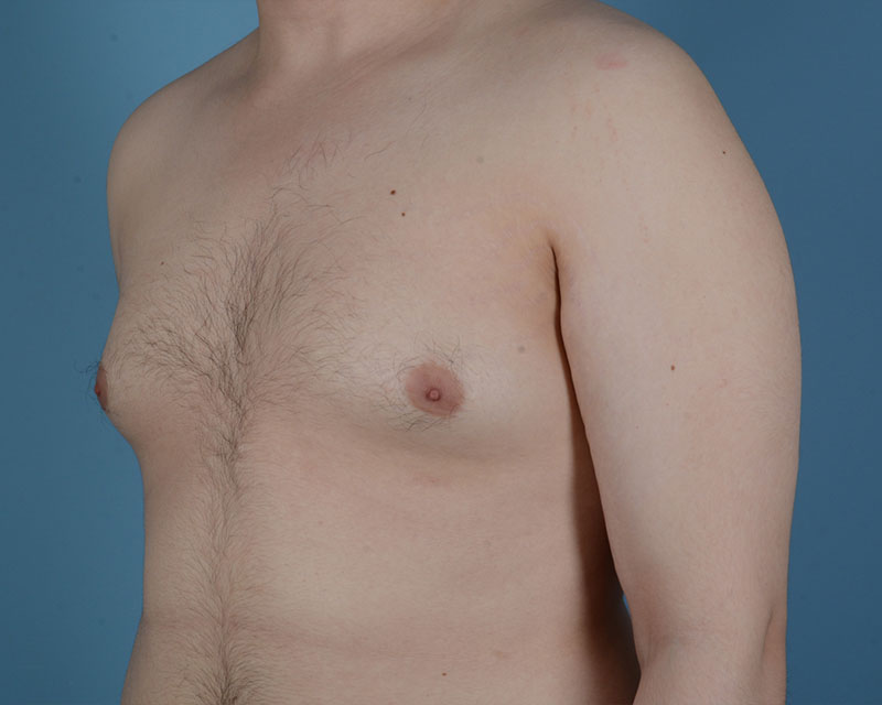 Gynecomastia Before and After | Dr. Thomas Hubbard