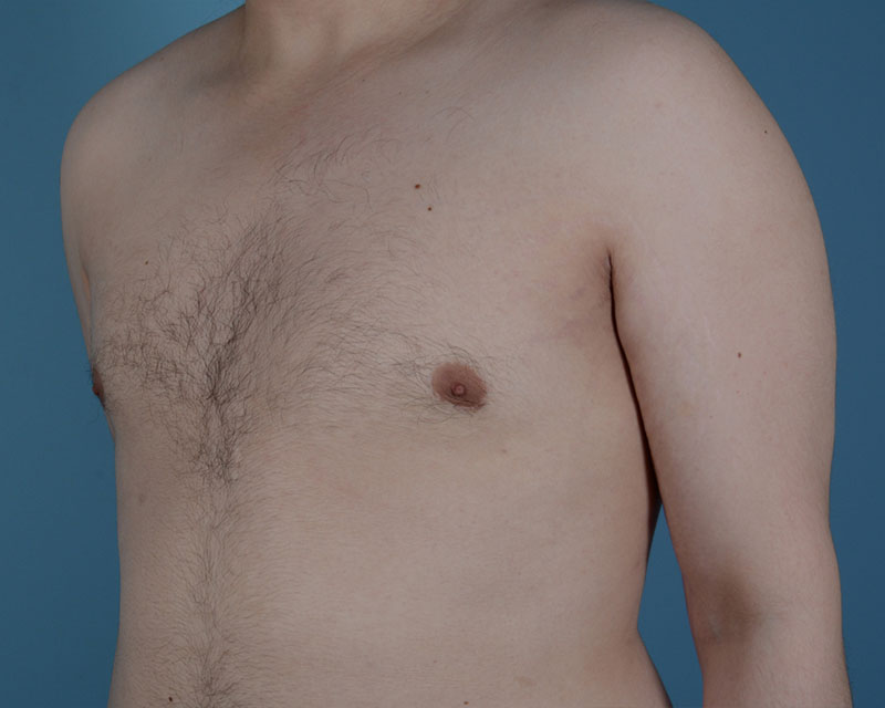 Gynecomastia Before and After | Dr. Thomas Hubbard