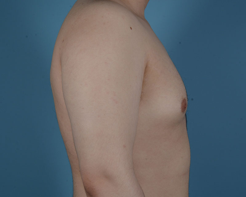 Gynecomastia Before and After | Dr. Thomas Hubbard