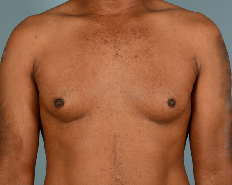 Gynecomastia Before and After | Dr. Thomas Hubbard