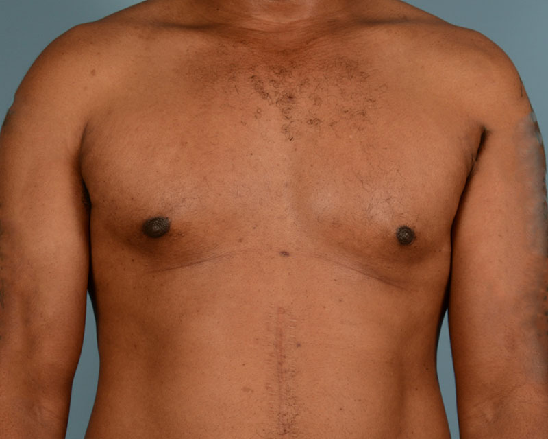 Gynecomastia Before and After | Dr. Thomas Hubbard