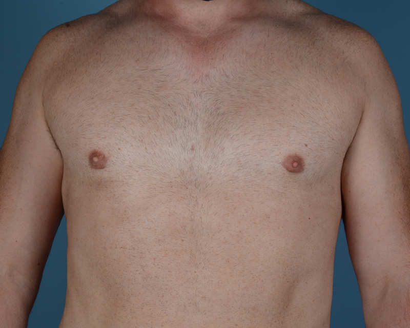 Gynecomastia Before and After | Dr. Thomas Hubbard