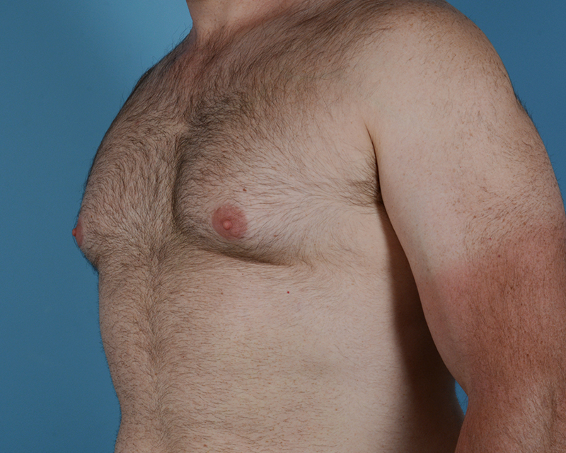 Gynecomastia Before and After | Dr. Thomas Hubbard