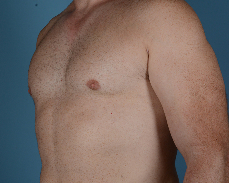 Gynecomastia Before and After | Dr. Thomas Hubbard